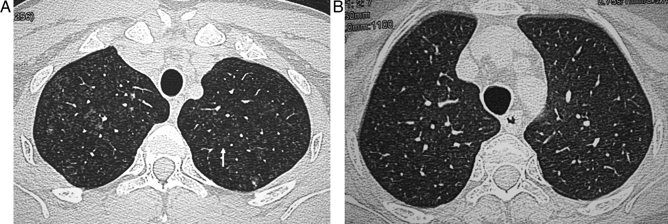82 J. Encinas et al Figura 10 Bronquiolitis respiratoria asociada a enfermedad pulmonar intersticial. Secciones de TCAR. A) Nódulos centrolobulillares mal definidos (flecha blanca).