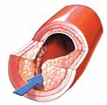 Arteria normal Torrente sanguíneo Acumulación de colesterol en la arteria (aterosclerosis) Placa Descripción de la cardiopatía aterosclerótica y los trastornos vasculares La aterosclerosis, o