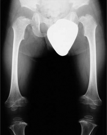 La radiología en las tallas bajas disarmónicas: Displasias óseas Figura 4a. Silla turca amplia y profunda. Figura 3. Epífisis pequeñas o todavía ausentes. Notable afectación metafisaria.