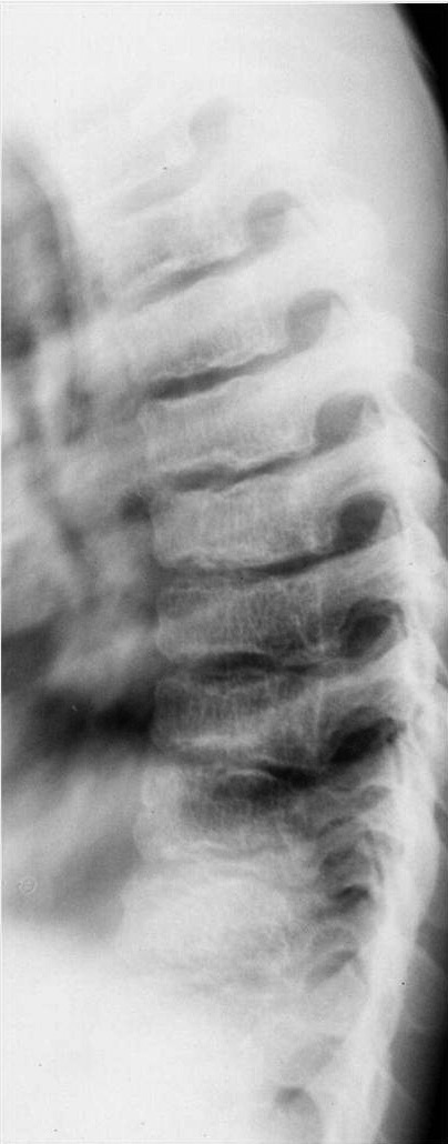 La radiología en las tallas bajas disarmónicas: Displasias óseas - Figura 7a.