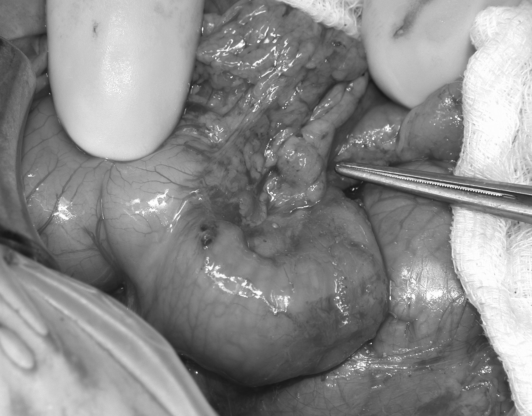 Leopoldo Martínez, Gloria Chocarro Figura 1. Imagen intraoperatoria en la que se señala con la pinza de disección la lesión situada en el proceso uncinado pancreático.