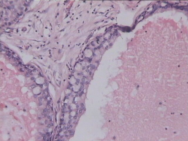 Carcinoma ductal in situ con células mucoides en el revestimiento