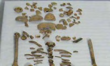 Informe de exhumación de fosa común en Casavieja (Ávila) Marzo de 2009 Estudio antropológico 33 Grado de conservación del material óseo muy deficiente.