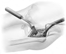 3 Capsulotomía anterior/superior 4 Colocación del extractor femoral Hudson A+ y osteotomía 7 Apertura del canal femoral con el osteotomo angulado A+ 8a Apertura del canal femoral con la raspa