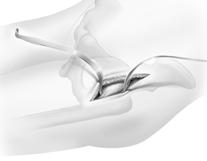 Verifique la longitud de las piernas en decúbito supino y establezca una correlación con las radiografías de cadera, para usarla como referencia más adelante.