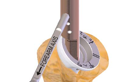 Vástago con una epífisis de Ø36 Conecte la raspa al mango en T Atornille la barra de retroversión sobre la raspa Impacte la raspa hasta que esté al mismo nivel de la altura de la superficie del hueso