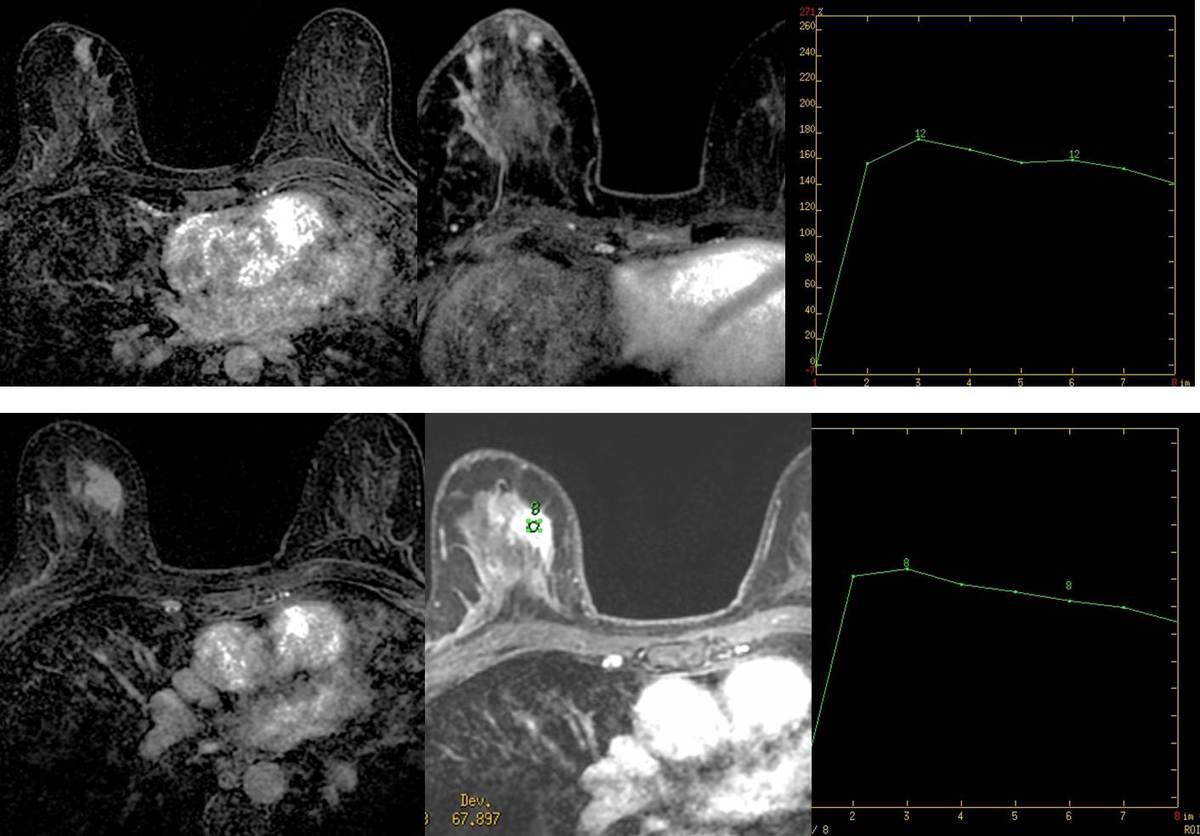 Fig. 7: Paciente con lesión sospechosa vista en mamografía y ecografía.