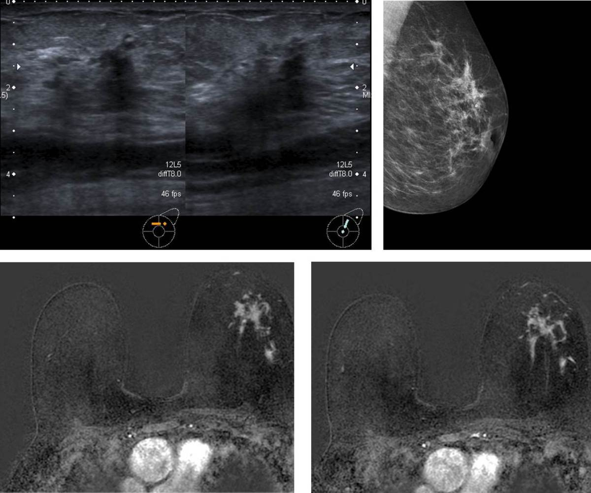 Fig. 8: Área mal delimitada en intercuadrantes superiores de mama izquierda visible en mamografía y