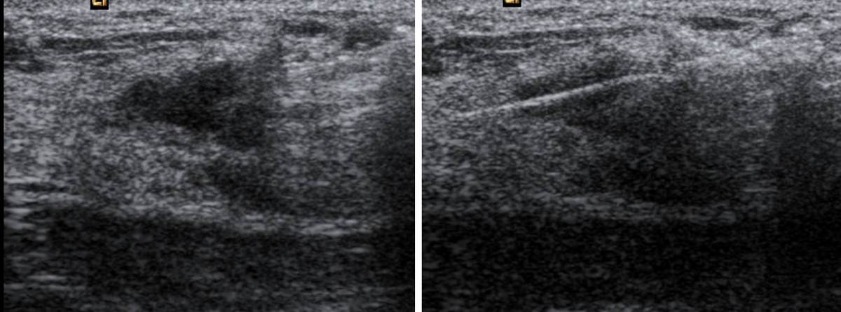 Images for this section: Fig. 1: RM de mama en mujer con lesión sospechosa vista con técnicas convencionales.
