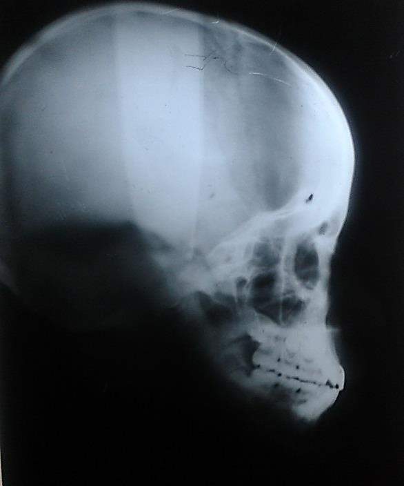 Metodología La muestra consistió en 136 radiografías lateral de cráneo, de las cuales 68 corresponden a cada grupo de edad.