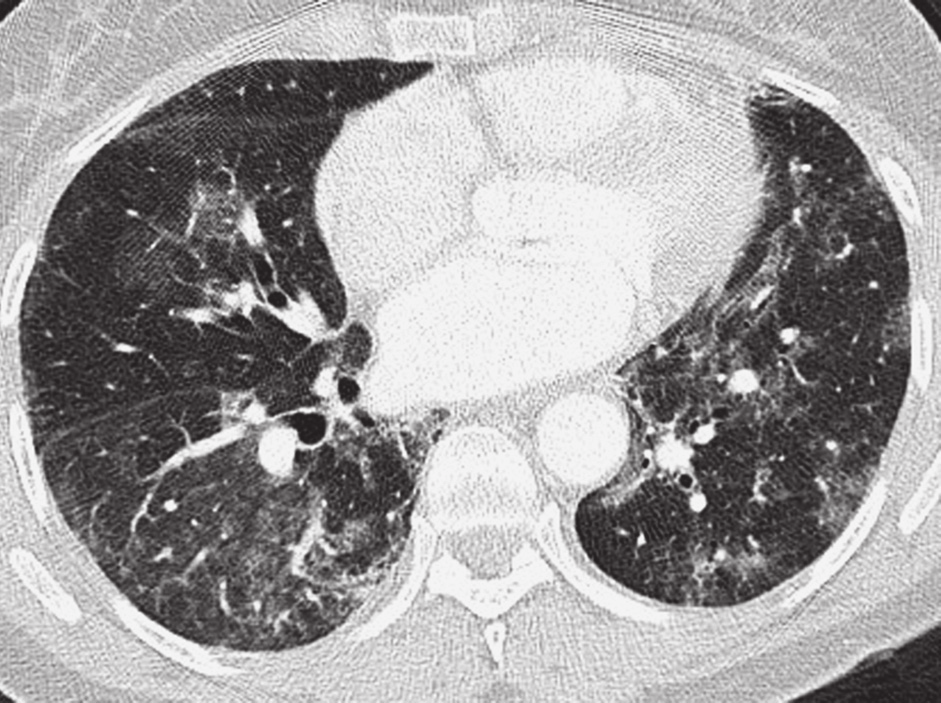 Recientemente se ha publicado una guía sobre el diagnóstico y manejo de la fibrosis pulmonar idiopática.
