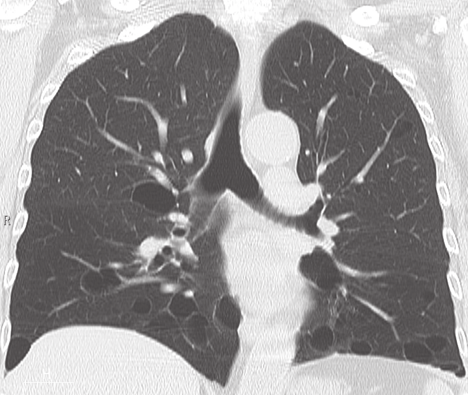 mayor densidad ( halo inverso ) (flechas). FIBROELASTOSIS PLEUROPARENQUIMATOSA La fibroelastosis pleuroparenquimatosa (FEPP) es una enfermedad pulmonar intersticial infrecuente.