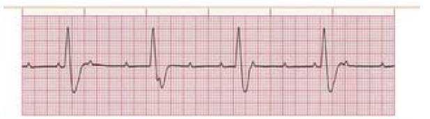 Hoja: 4 de 9 2. Actividad eléctrica sin pulso: Se refiere a cualquier actividad eléctrica organizada que se observe en el ECG o el monitor cardiaco en un paciente sin pulso palpable.