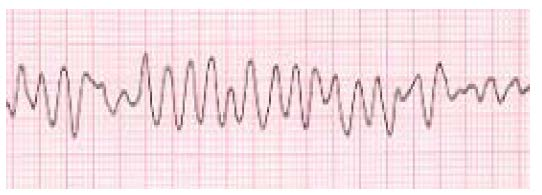 El ECG puede mostrar complejos QRS normales o anchos, o bien otras alteraciones como: a) Ondas T de baja o alta amplitud b) Intervalos PR o QT prolongados c) Disociación AV o bloqueo cardiaco