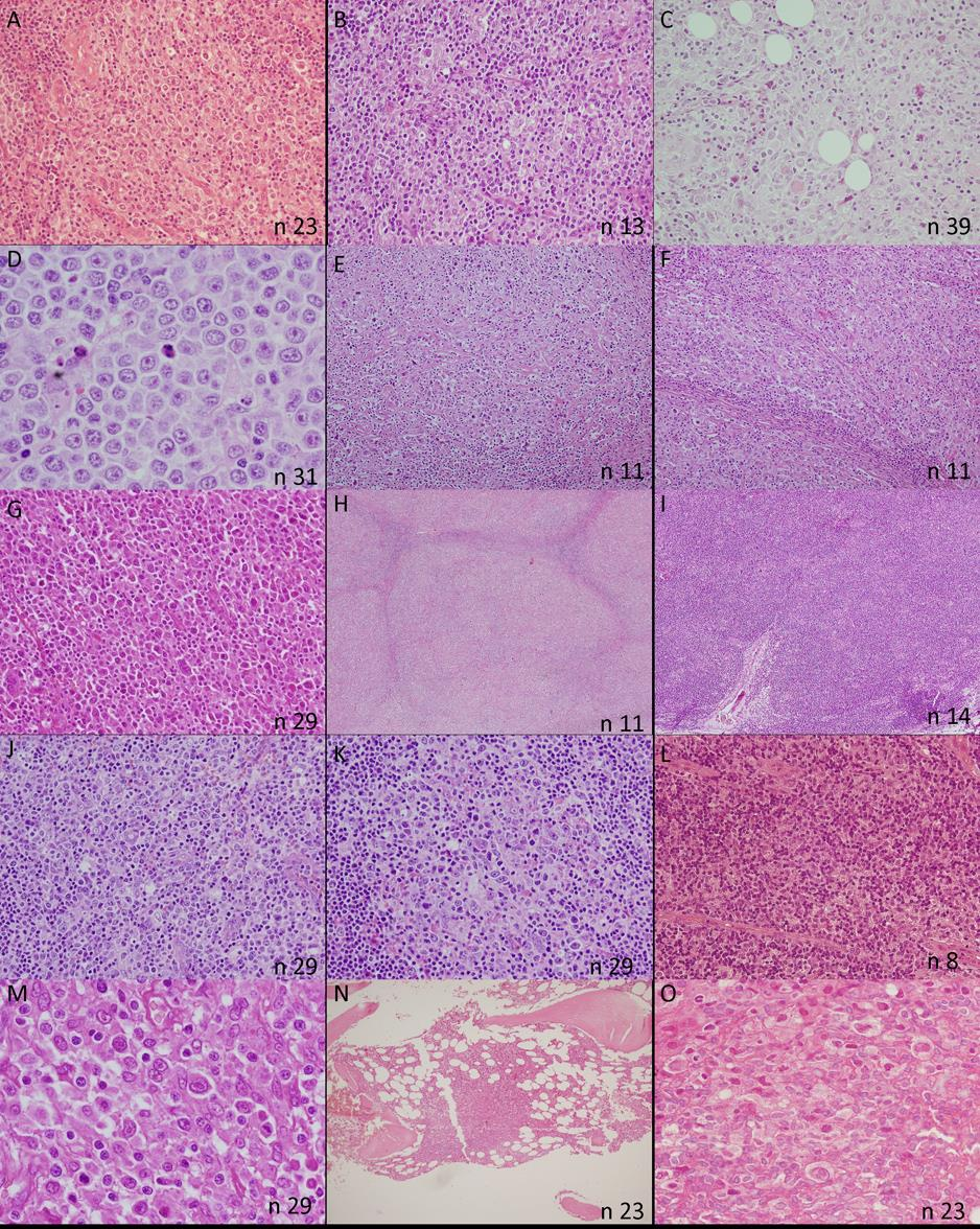 Figura 12. Características histopatológicas de los casos de linfoma B difuso de célula grande asociado a EBV y edad avanzada.