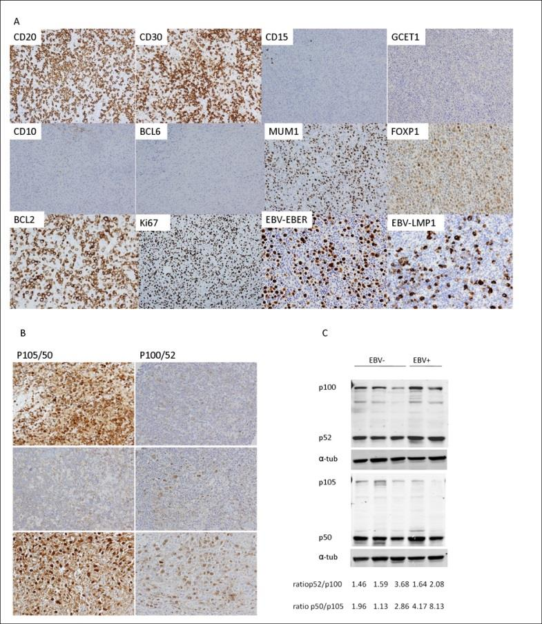 Figura 13. El linfoma B difuso de células grandes EBV positivo muestra un perfil fenotípico ABC con marcada activación de NFkB y sobreexpresión de BCL2.
