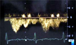 Evaluación del flujo de las venas pulmonares con ecocardiografía transtorácica 323 la duración de la onda A mitral, la cual fue menor en los pacientes con síntomas que en los pacientes asintomáticos