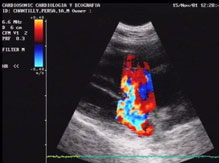 Electrocardiográficamente, es frecuente observar signos de crecimiento de ventrículo derecho, o la aparición de signos de bloqueo de rama derecha.