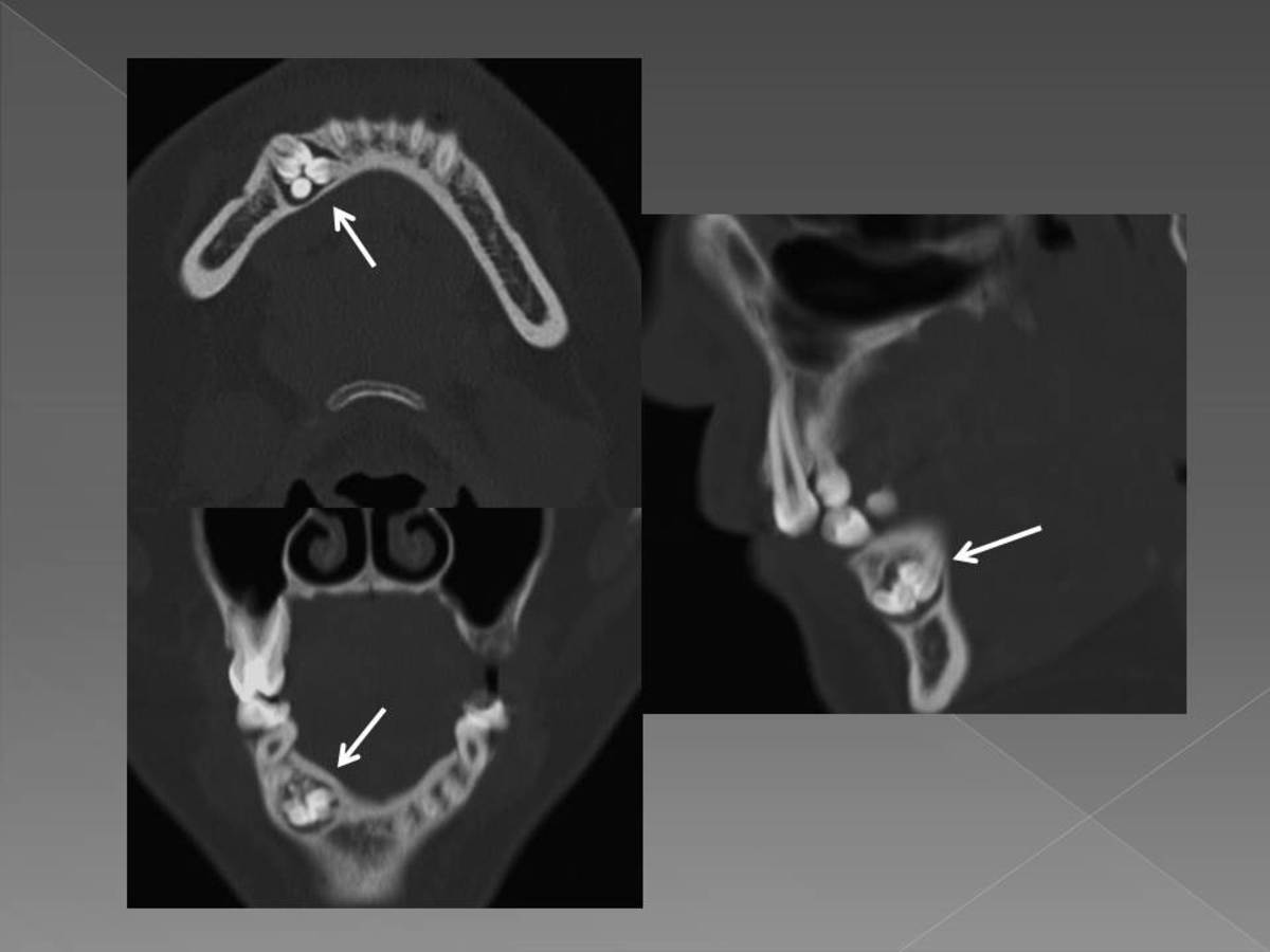 Fig. 15: Lesión esclerótica que contiene múltiples masas de tejido dental