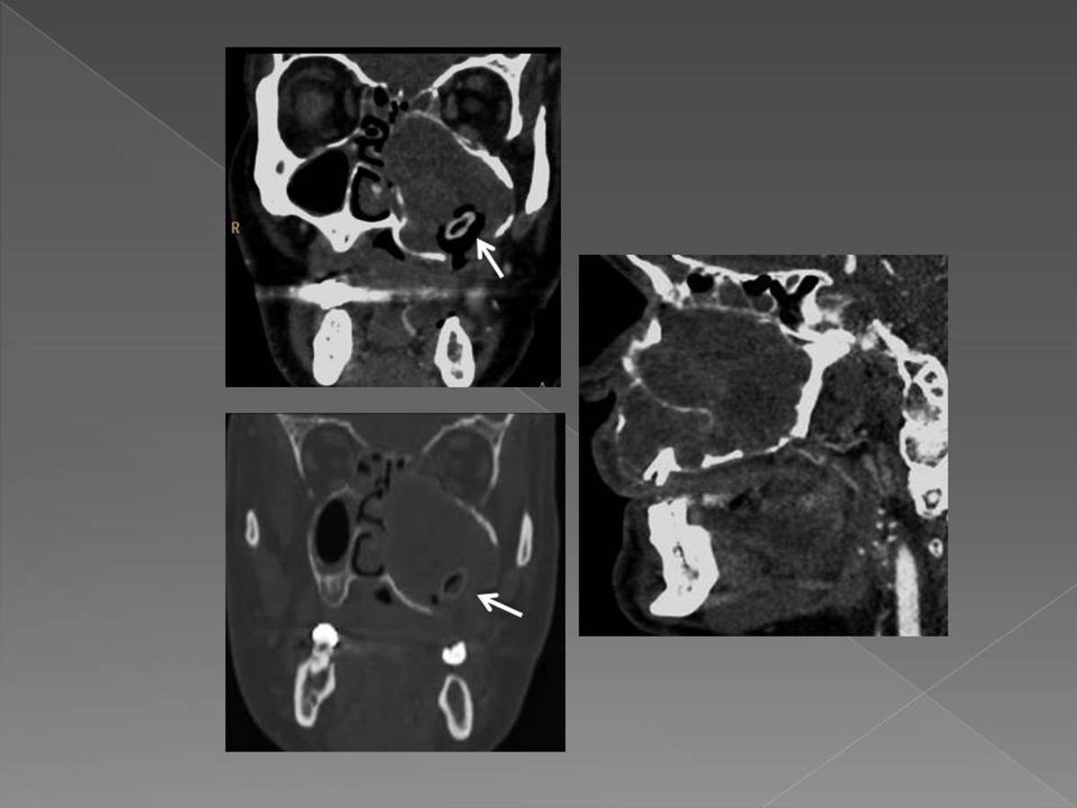 Fig. 16: Lesión quística expansiva, multiloculada dentro del seno maxilar izquierdo.