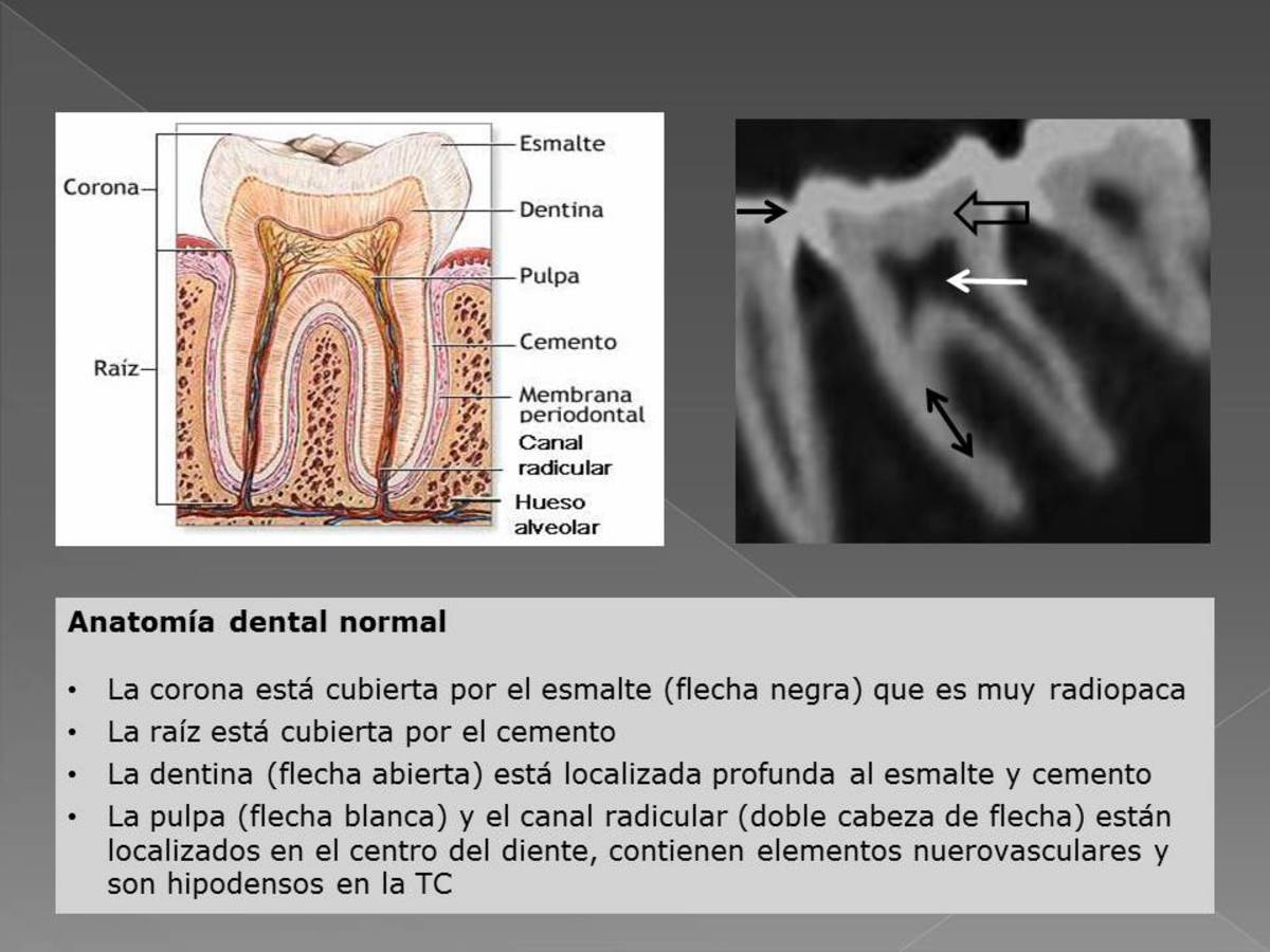 Fig. 1 Referencias: Hospital de Cruces - Baracaldo/ES 2. Enfermedad inflamatoria La enfermedad inflamatoria se ve con facilidad en la TC. Se divide en enfermedad endodontal y periodontal.