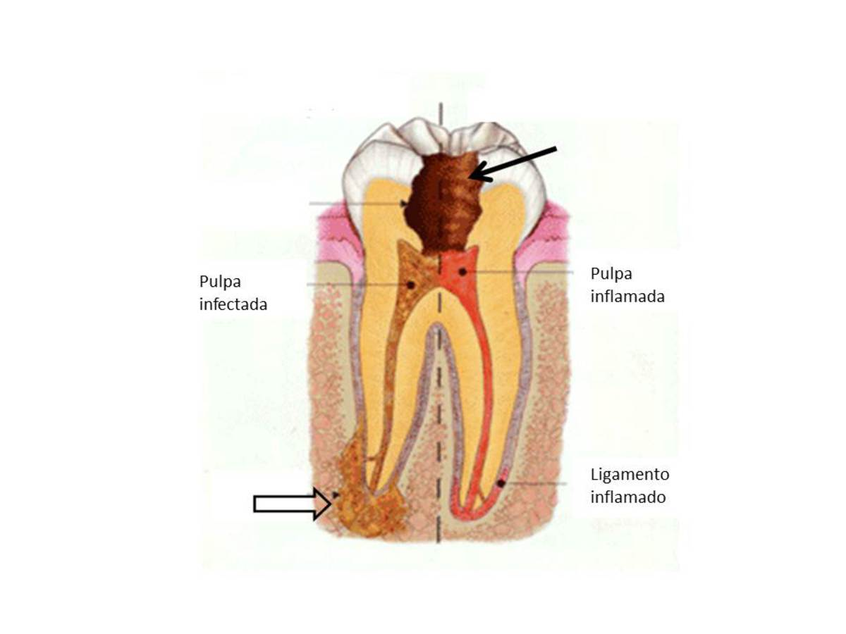 Fig. 2 Referencias: James P, Walker, DDS, PC Tualatin endodontics Enfermedad periodontal: la infección empieza con la inflamación de la encía (gingivitis), se extiende a
