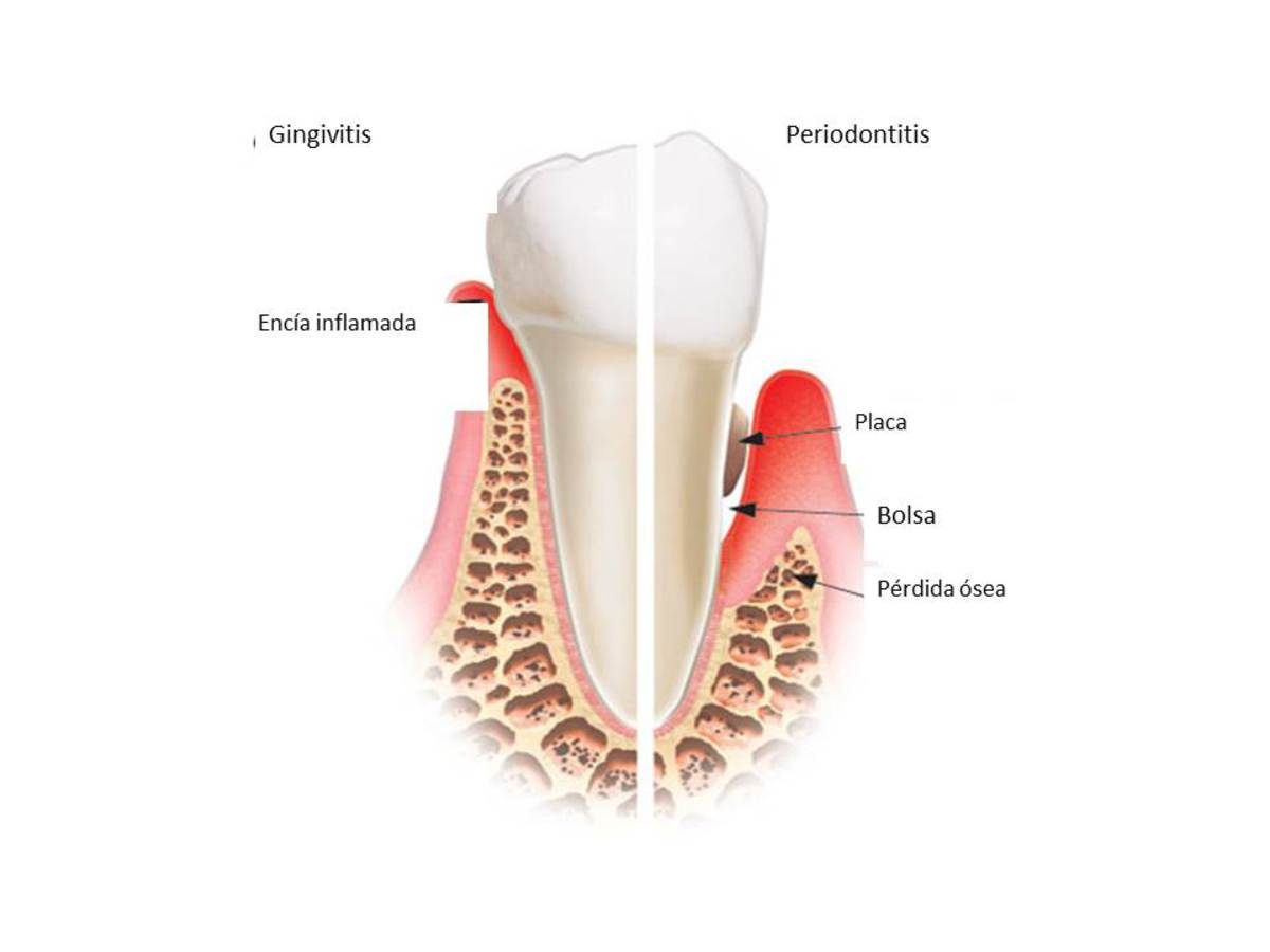 Fig. 3 Referencias: James P. Walker, DDS, OC Tualatin endodontics 2.A Enfermedad endodontal (Fig.