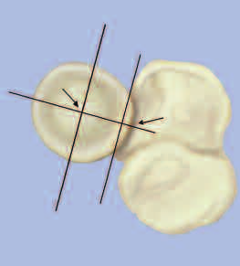 FUNMENTOS EL ISEÑO E L EZ (Referencia 1-5,10,11) FORM ELÍPTI La prótesis anatómica de cabeza radial de cumed presenta una cabeza de forma elíptica.