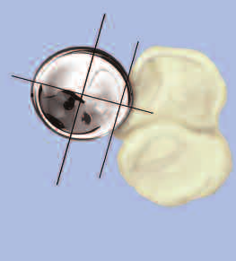 omo se muestra en la imagen de la derecha, la orientación del eje diametral mayor es perpendicular a la muesca radial cuando el antebrazo se encuentra en posición neutra 1-5,10.