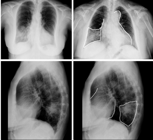 Fig. 3. Signo de la silueta en neumonía de LID. no de la silueta ), la lesión se encontrará localizada en los lóbulos pulmonares inferiores, mediastino posterior o cavidad pleural posterior.