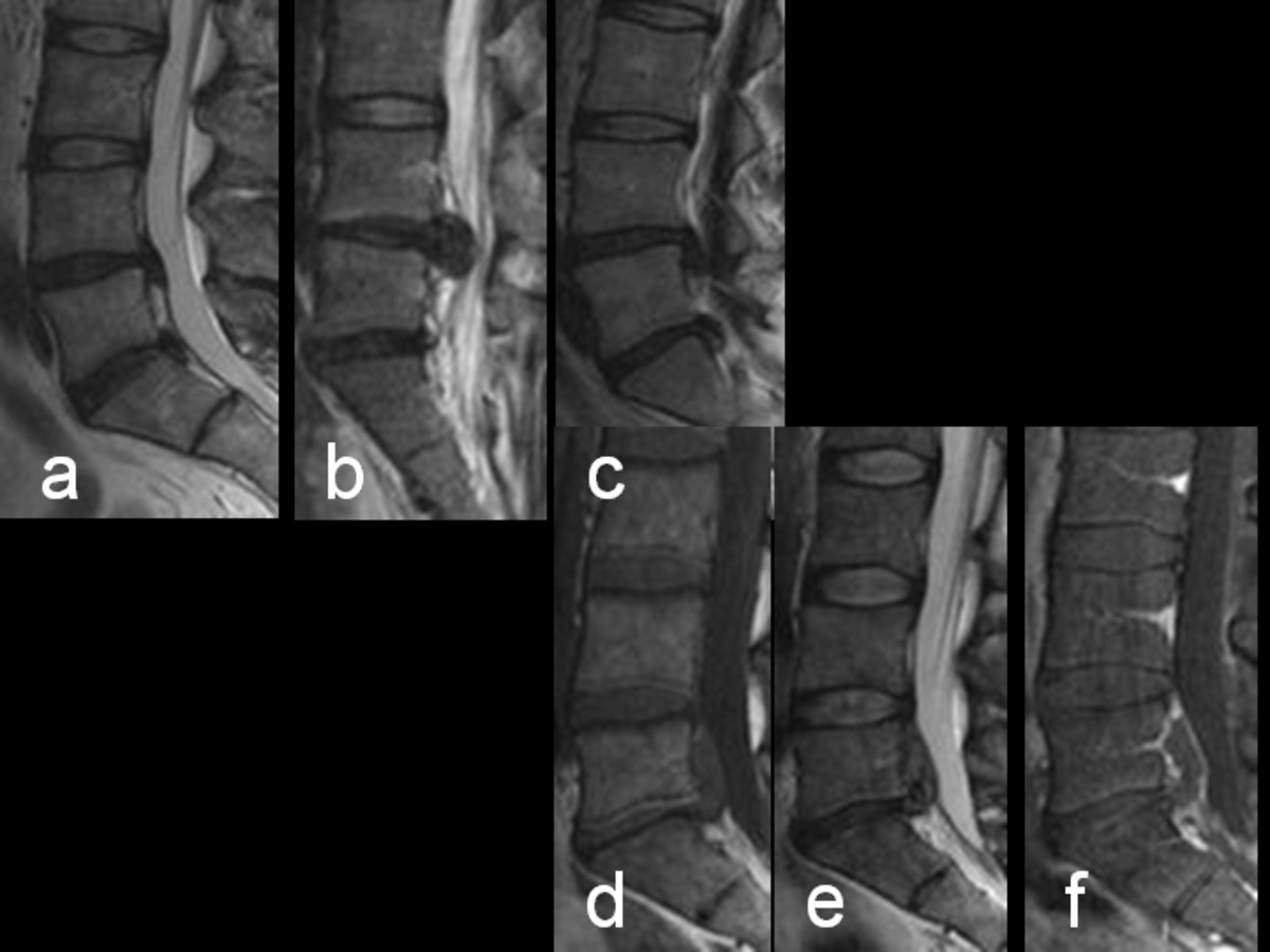 Fig. 17: Imágenes RM sagital. a. SE-T2. Hernias subligamentosas. b. SE-T2. Gran hernia extruida. c. SE-T2. Hernia migrada caudalmente. d. SE-T1 y e. SE-T2. Hernia con componente de hematoma.