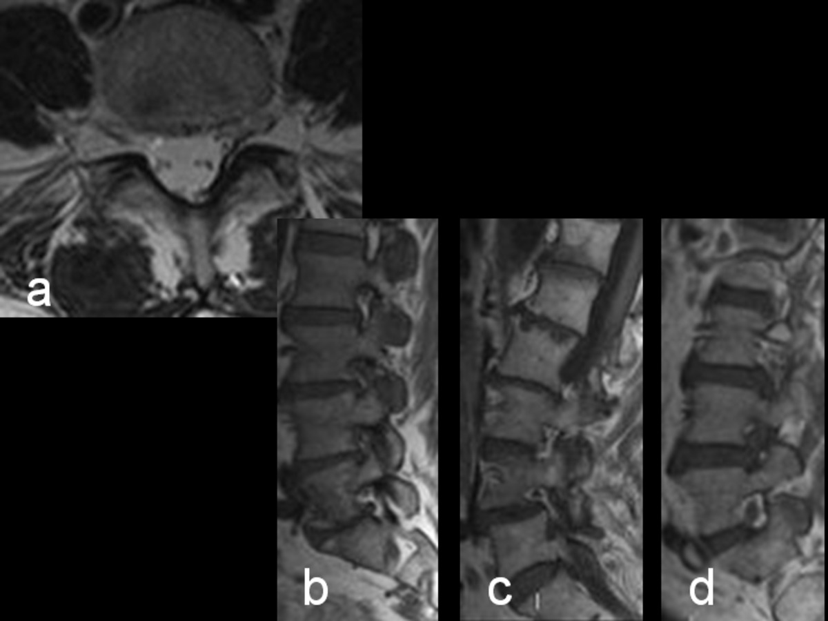 Fig. 23: Imágenes RM que muestran: a. Variante anatómica. Salida de doble raíz. b.