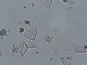 _ Foto 3: En esta foto se observan cristales de ácido úrico.