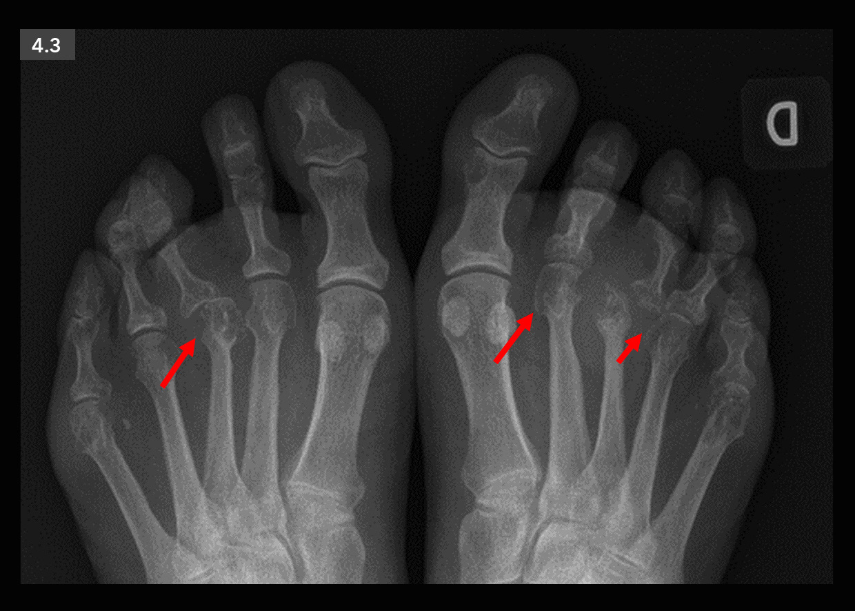 Artritis reumatoide. Resonancia magnética Figura 4.2 A-C RM de pie con cortes sagitales en secuencias T2 (A), T1 (B) y T1 con saturación de la grasa tras contraste intravenoso (C).
