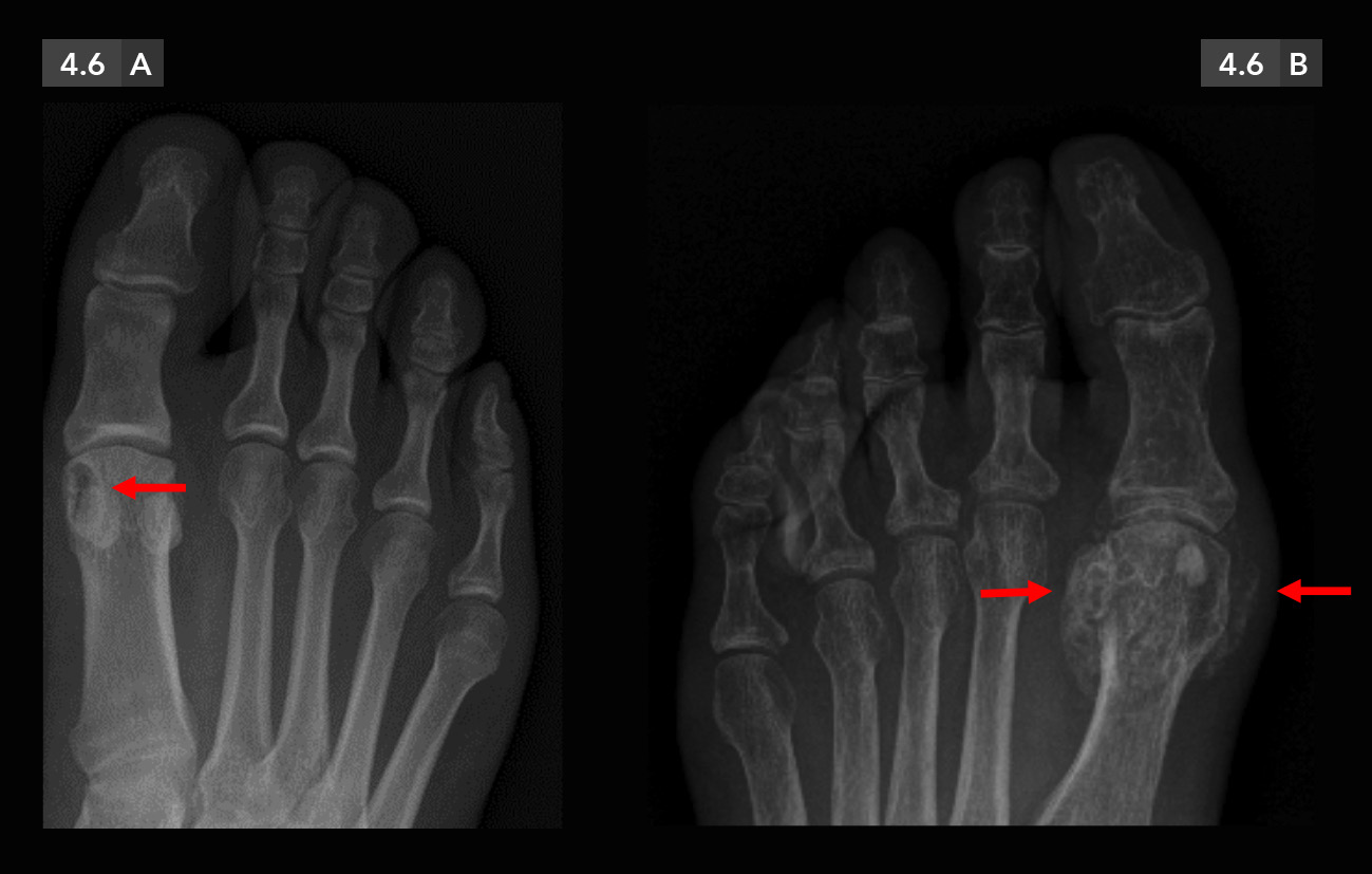 Extremidad inferior / Tobillo y pie / Patología articular / Espondiloartropatías seronegativas Caso 4.6. Artropatías por depósito de cristales (gota).