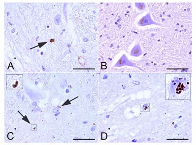 Apoptosis TUNEL: -Glías positivas en scrapie y control - No marcaje en neuronas TUNEL Caspasa-3 Caspasa-3 Caspasa-3 CASPASA-3 ACTIVA: - Se observa en neuronas sin aspecto apoptótico tanto en scrapie