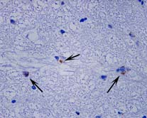 control Falta de evidencias de apoptosis Poca densidad