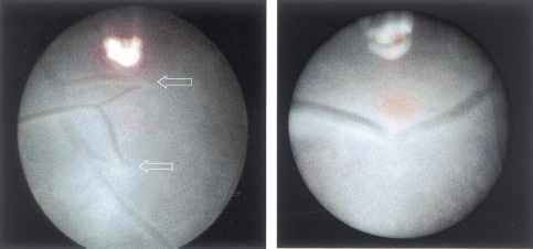 344 A B Figura 1. Visión fetoscópica de la placa corial. Imagen de los vasos coriales.