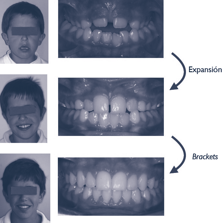 Obstrucción de la vía aérea superior y deformidades dentofaciales 239 aparatos de ortodoncia/ortopedia diseñados expresamente para inducir cambios esqueléticos son capaces de mejorar la permeabilidad