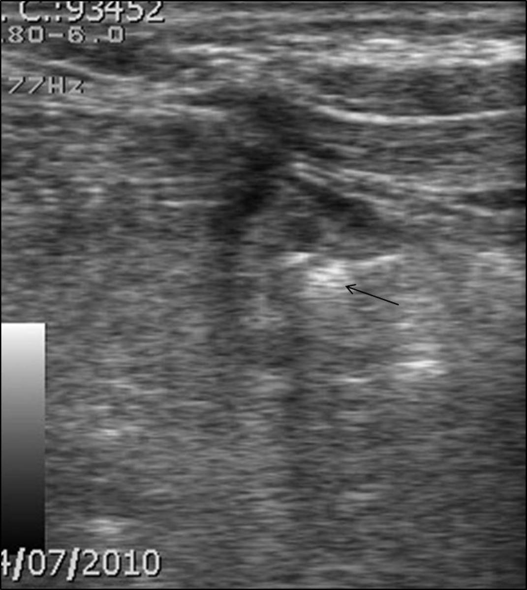 Fig. 3: Corte axial en flanco izquierdo donde observamos el colon descendente con engrosamiento de la pared muscular y con una