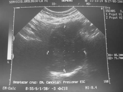 FIGURA 1. Imagen de ecografía vesicoprostática donde se observa el gran tamaño de la próstata (400 ml). FIGURA 2.