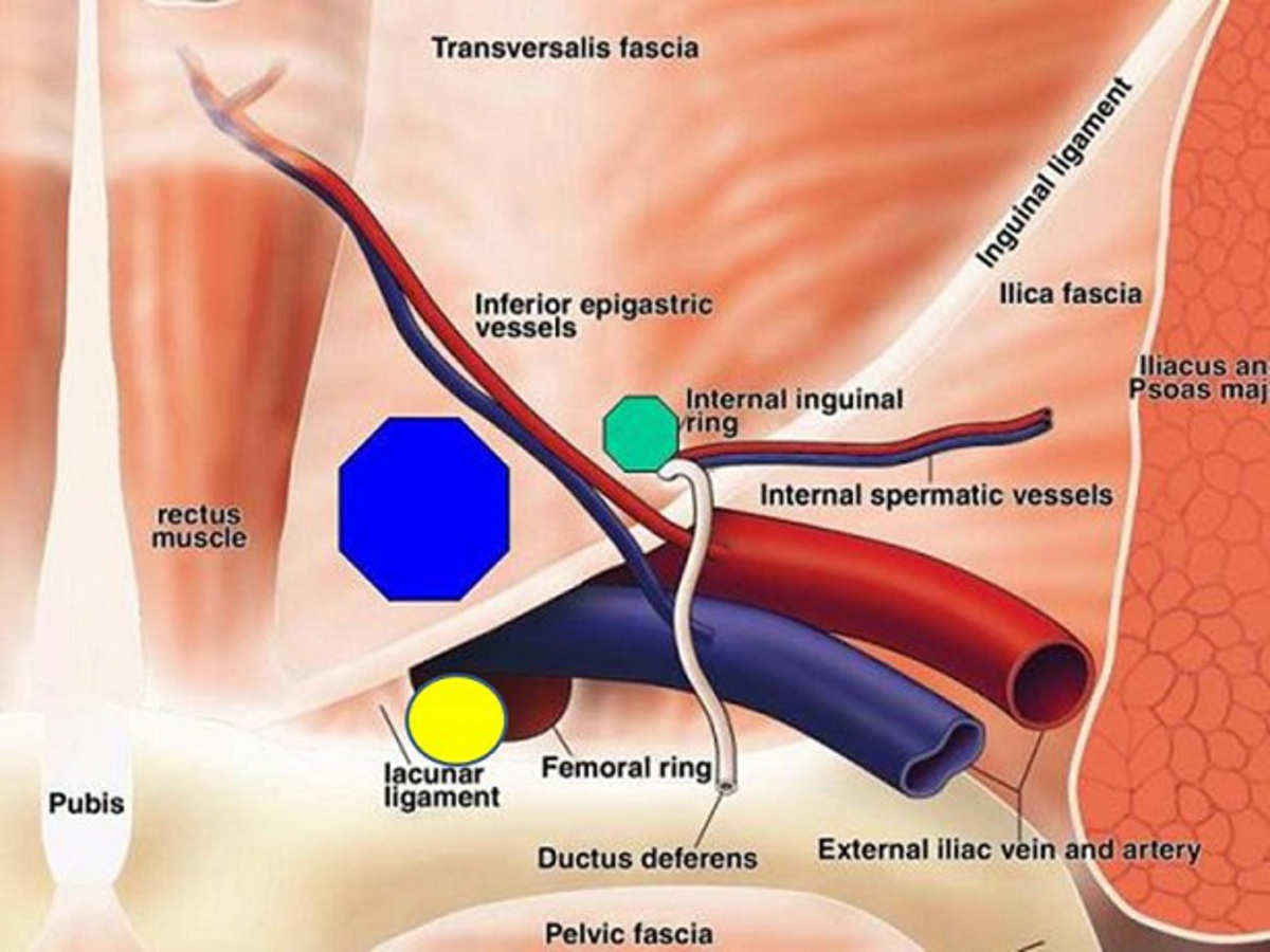 Fig. 1: Diagrama anatómico de la región inguinal y femoral que muestra la localización de las hernias inguinales directa (círculo azul), indirecta