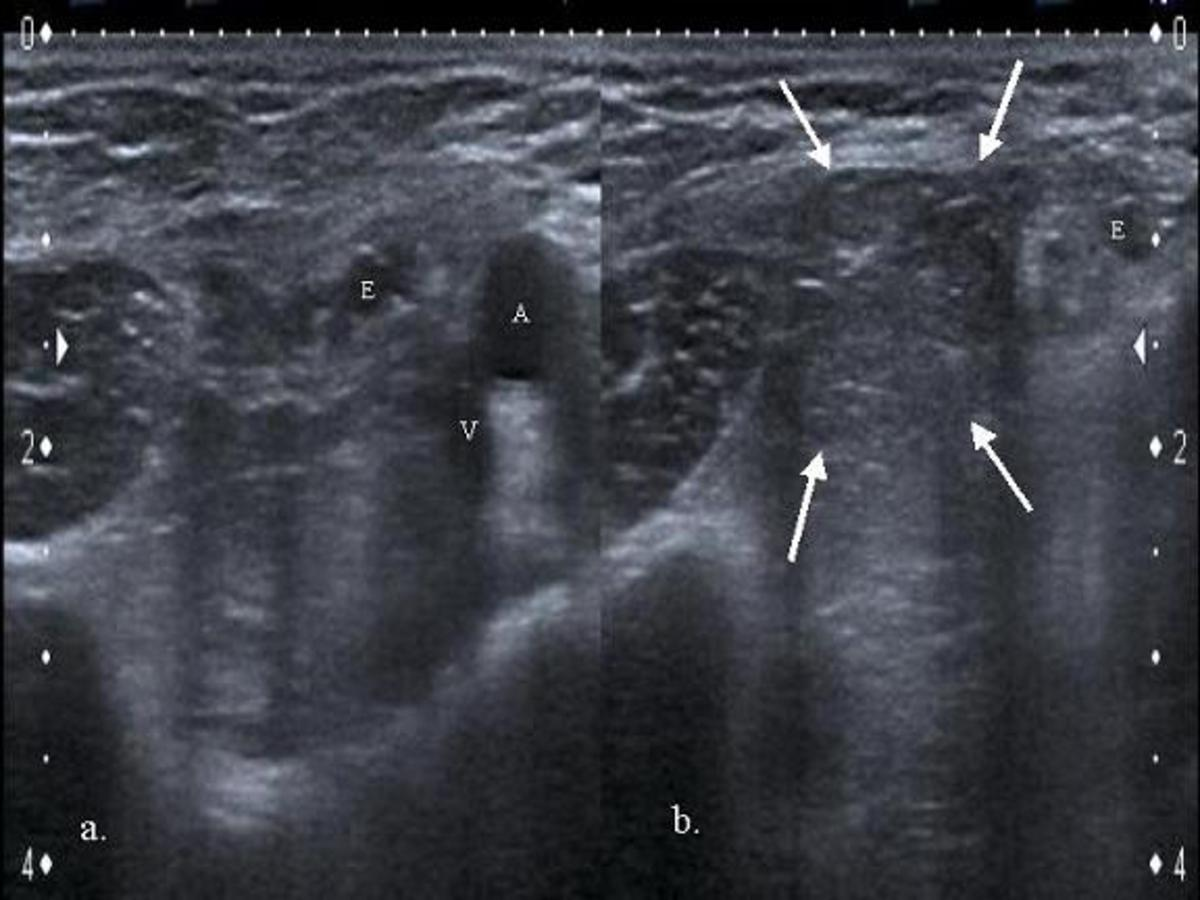 Fig. 5: La imagen "a" muestra la región inguinal izquierda en reposo, identificándose los vasos epigástricos inferiores (E) y la arteria (A) y vena (V) ilíacas externas.