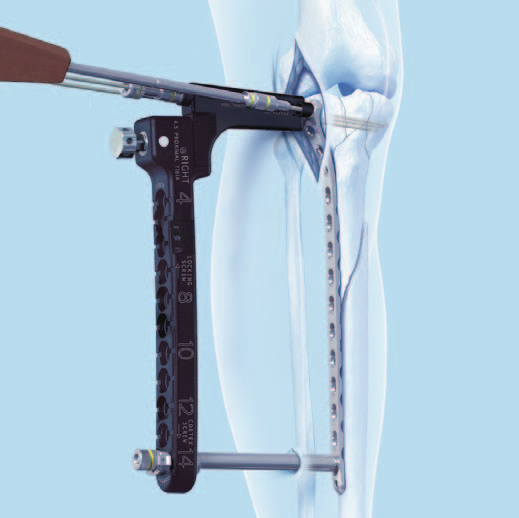 Técnica quirúrgica Extraiga los conjuntos anterior y posterior de guía de centrado y, sobre la aguja guía, inserte en el hueso sendos tornillos de la longitud adecuada, con ayuda del destornillador