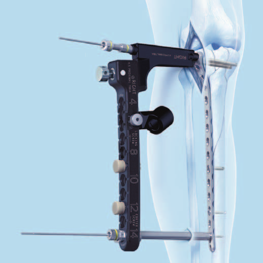 Técnica quirúrgica Nota: Si tiene previsto utilizar la guía angulada para el agujero angulado de la placa, no coloque ningún tornillo en el agujero del cuerpo de la placa que ocupa la broca o la