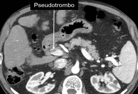 Fig. 3: Pseudotrombosis portal A) TCMD en fase arterial tardía muestra defecto de relleno central en la vena porta principal que puede simular un trombo.