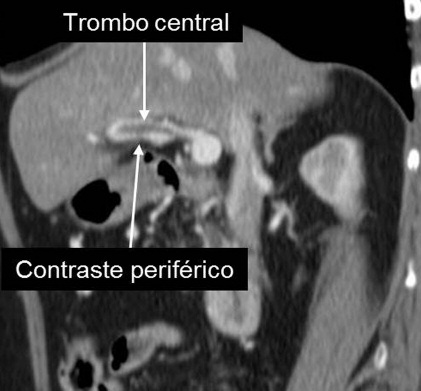 Trombosis portal aguda La fase portal es la más importante para detectar la trombosis de este vaso y la circulación colateral (1).