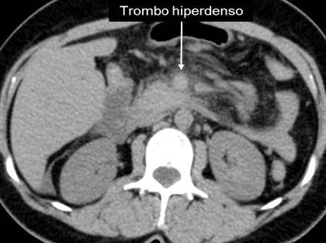 Fig. 6: Trombosis aguda por TCMD.