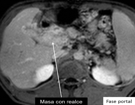 12: Cavernoma pseudo-tumoral A) RM secuencia T2 coronal que muestra una masa en el hilio hepático de señal