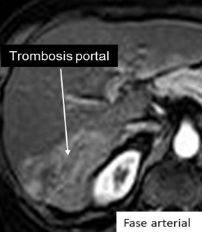Fig. 13: Trombosis portal tumoral. a b c d A) RM T1 fat-sat fase arterial: Trombosis portal segmentaria con hiperperfusión hepática.